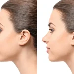 عوارض بینی فانتزی؛ چگونه از نتیجه مصنوعی یا تنگ شدن راه هوایی جلوگیری کنیم؟