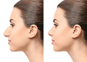 عوارض بینی فانتزی؛ چگونه از نتیجه مصنوعی یا تنگ شدن راه هوایی جلوگیری کنیم؟