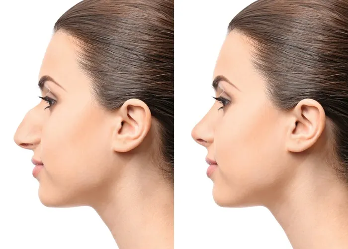 عوارض بینی فانتزی؛ چگونه از نتیجه مصنوعی یا تنگ شدن راه هوایی جلوگیری کنیم؟