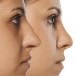 آیا ساختار داخلی بینی می‌تواند نتیجه جراحی زیبایی بینی را محدود کند؟