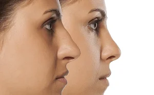 آیا ساختار داخلی بینی می‌تواند نتیجه جراحی زیبایی بینی را محدود کند؟