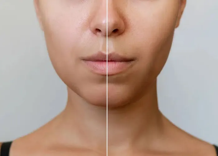 تاثیر حذف بوکال فت بر فرم صورت