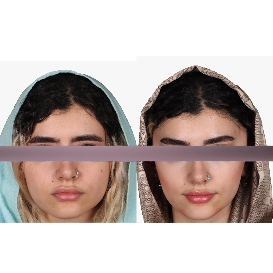 جراحی پلک بالا