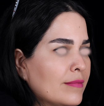 بلفاروپلاستی