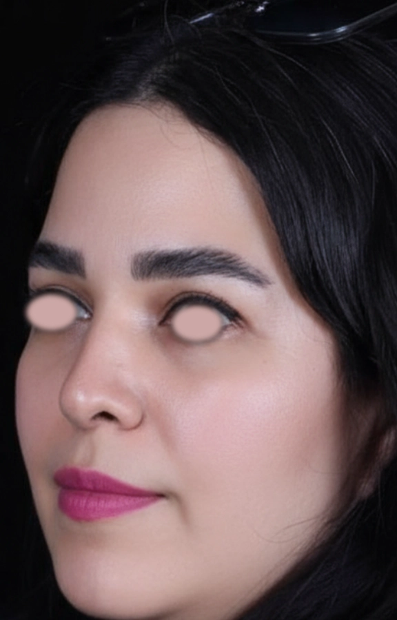 بلفاروپلاستی