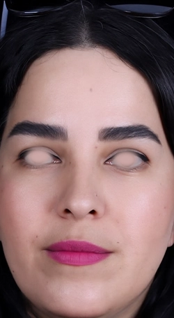 بلفاروپلاستی