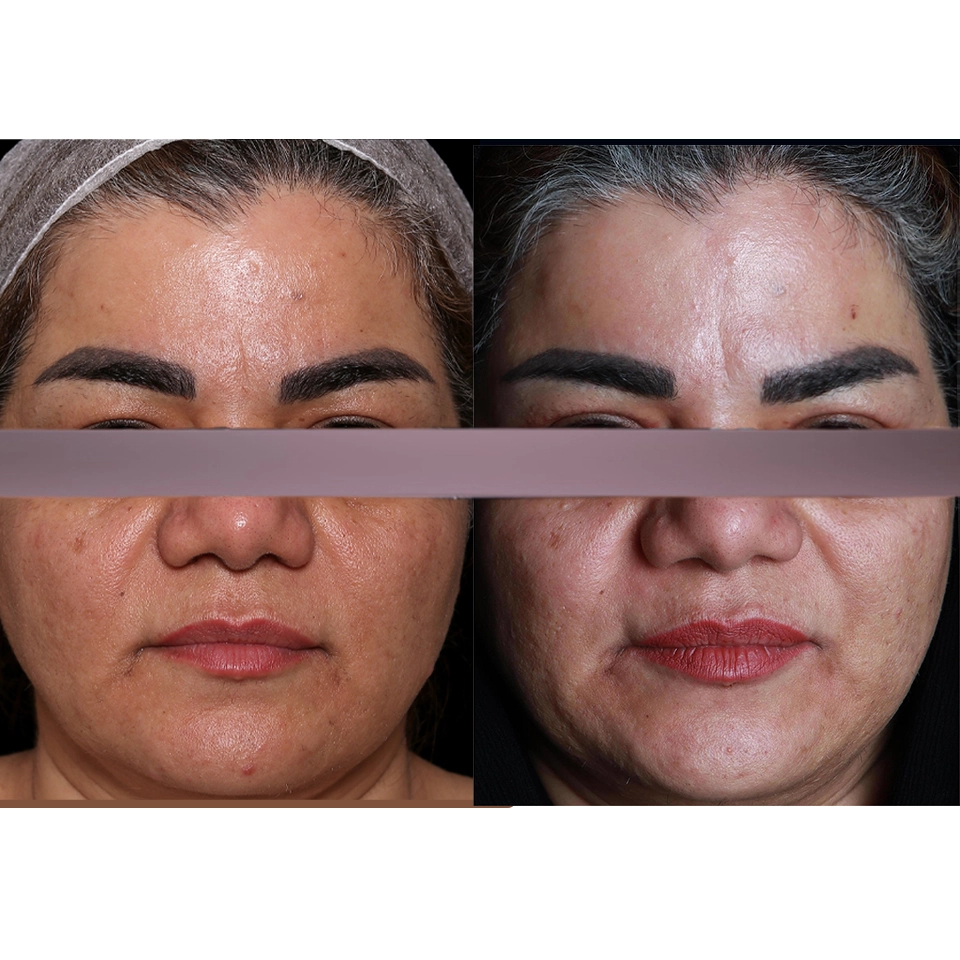 جراحی پلک بالا