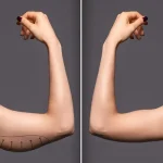 بازو بعد از لیپوماتیک دچار افتادگی یا شلی پوست می‌شود؟