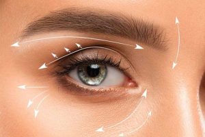 تأثیر بلفاروپلاستی پلک بالا بر دید و میدان بینایی؛ چه انتظاری داشته باشیم؟