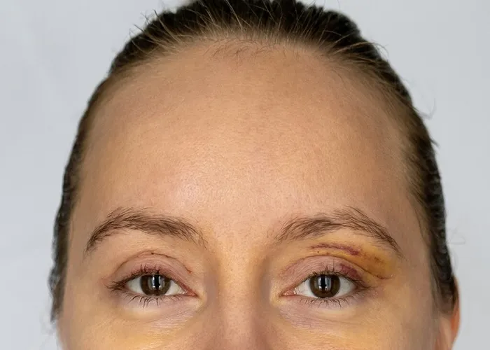 سنگینی پلک بعد از بلفاروپلاستی