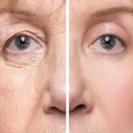 برخی از افراد چرا بعد از بلفاروپلاستی احساس سنگینی پلک دارند؟