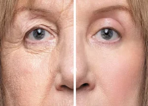 برخی از افراد چرا بعد از بلفاروپلاستی احساس سنگینی پلک دارند؟