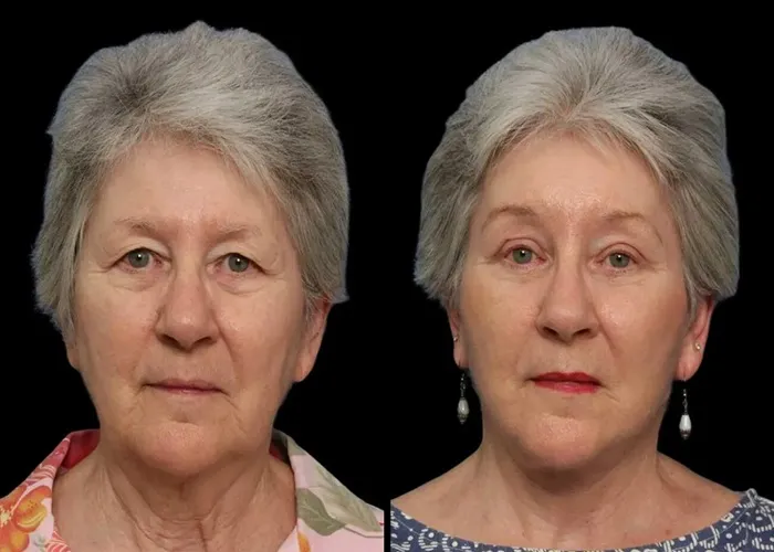 سنگینی پلک بعد از بلفاروپلاستی