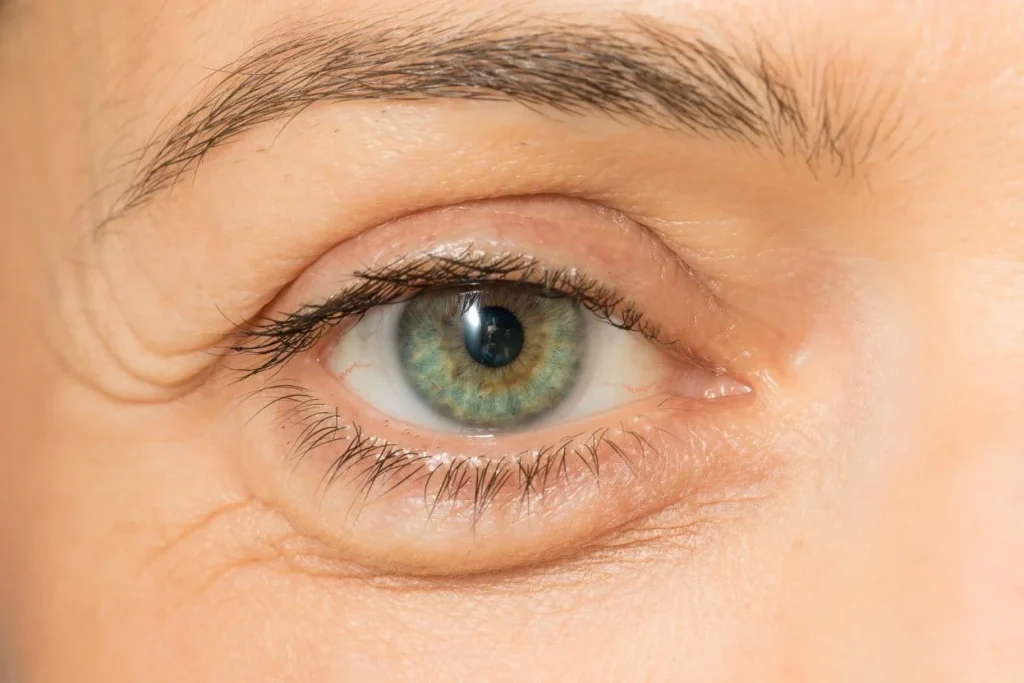 تکنیک‌های مدرن کاهش پف پلک پایین و تفاوت نتایج با روش‌های قدیمی