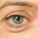 تکنیک‌های مدرن کاهش پف پلک پایین و تفاوت نتایج با روش‌های قدیمی