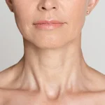 پلاتیسماپلاستی برای رفع غبغب گردن: چه زمانی باید انجام شود؟