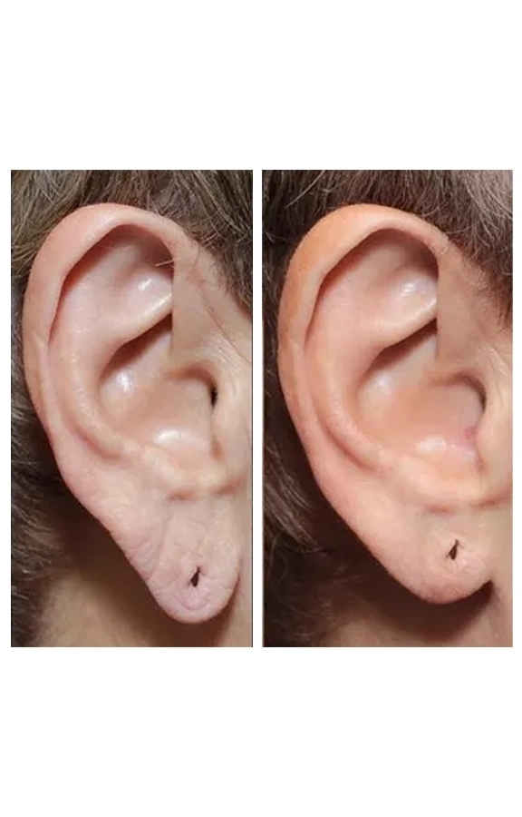 جراحی زیبایی لاله گوش