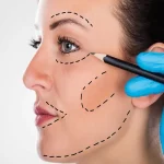 تاثیر لیفت گونه و لیفت صورت بر نمای سه بعدی چهره