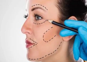 تاثیر لیفت گونه و لیفت صورت بر نمای سه بعدی چهره