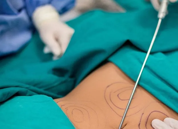 ناهمواری پوست بعد از لیپوماتیک شکم