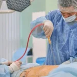 دلایل ایجاد ناهمواری پوست بعد از لیپوماتیک شکم