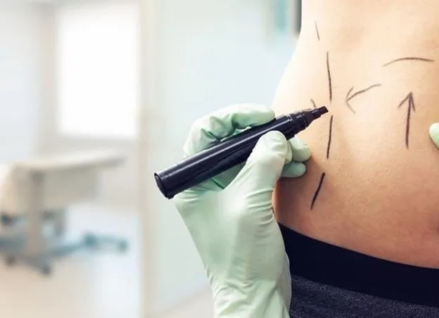 ناهمواری پوست بعد از لیپوماتیک شکم