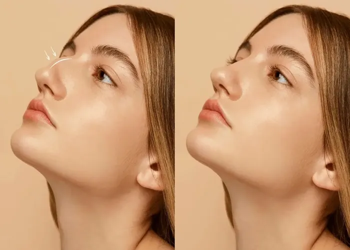  میزان سختی عمل بینی گوشتی یا استخوانی