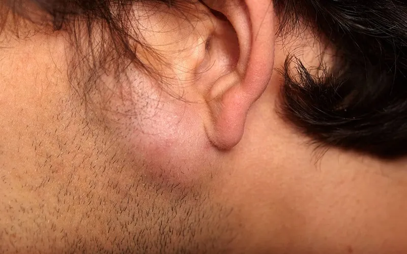 سفت شدن چربی تزریق‌ شده