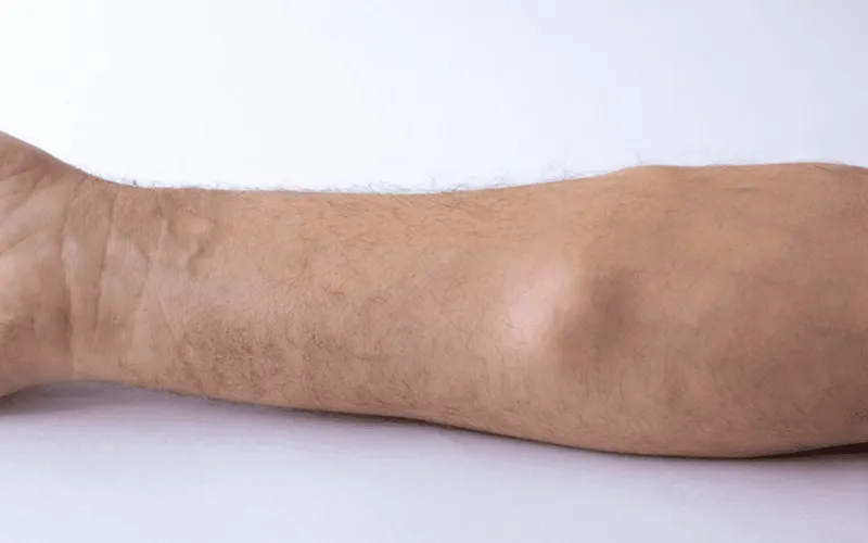 سفت شدن چربی تزریق‌ شده