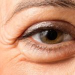 علت اینکه صبح ها زیر چشم پف میکند چیست؟