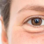 اصلاح افتادگی ظریف پلک و بهبود فرم چشم با روش‌های کم‌تهاجمی