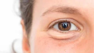 اصلاح افتادگی ظریف پلک و بهبود فرم چشم با روش‌های کم‌تهاجمی