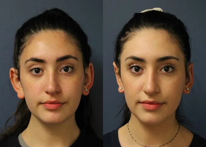 فرمدهی غضروف گوش بدون شکستگی