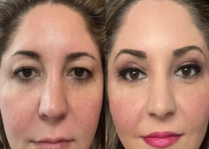 اشک‌ریزی بعد از بلفاروپلاستی