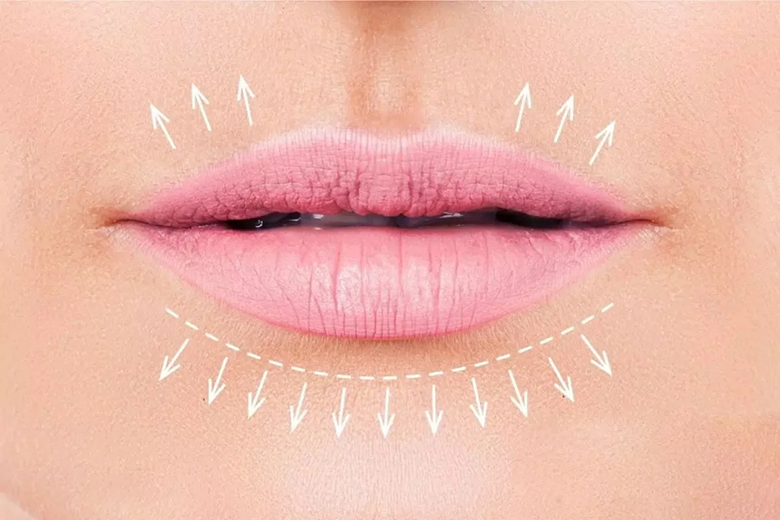 کاربردی ترین روش کم کردن فاصله لب و بینی بدون جراحی