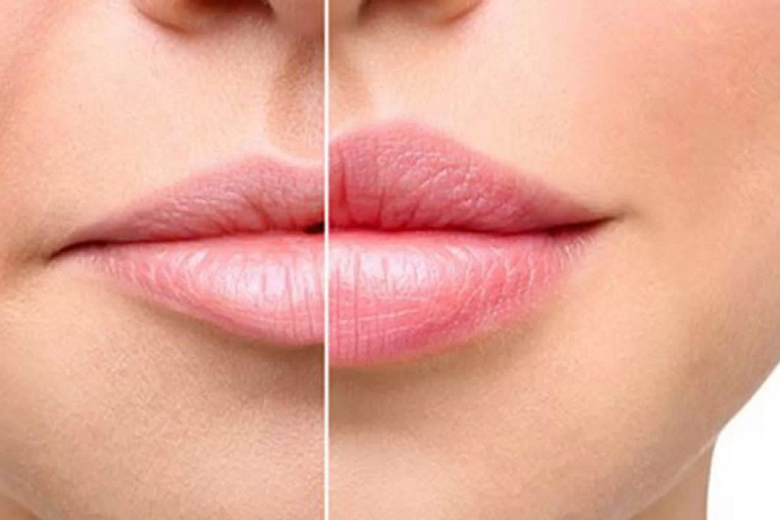 کم کردن فاصله لب و بینی بدون جراحی