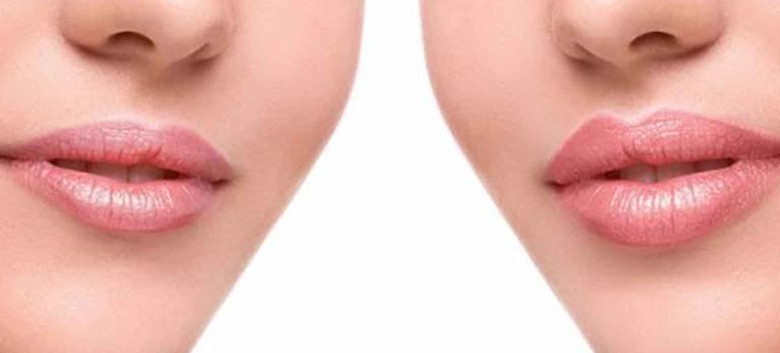 کم کردن فاصله لب و بینی بدون جراحی
