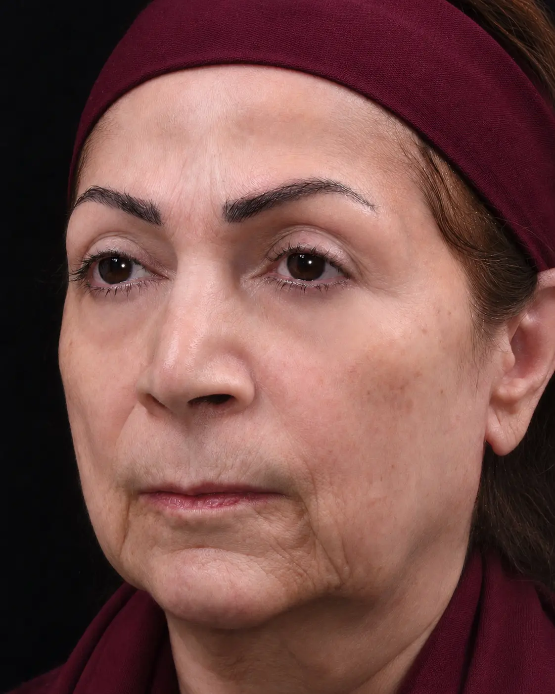 بلفاروپلاستی