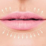 کاربردی ترین روش کم کردن فاصله لب و بینی بدون جراحی