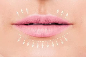 کاربردی ترین روش کم کردن فاصله لب و بینی بدون جراحی