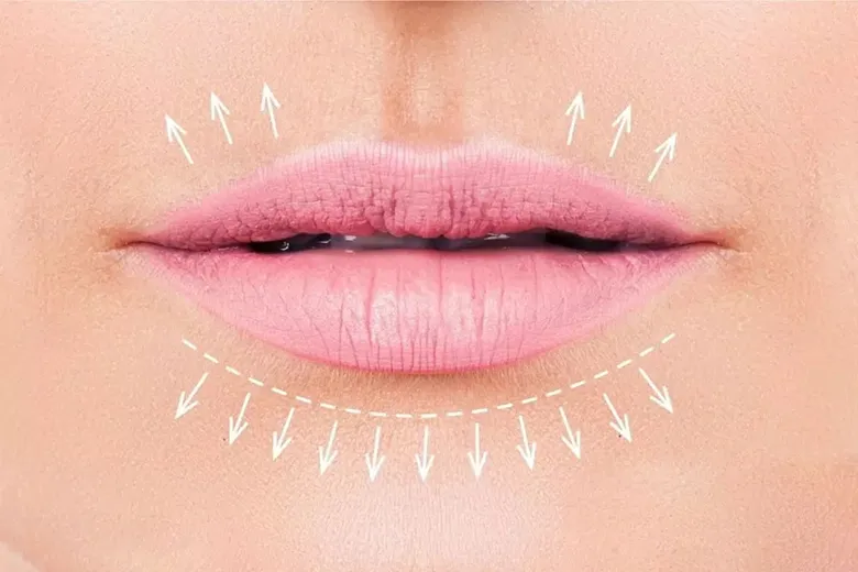 کاربردی ترین روش کم کردن فاصله لب و بینی بدون جراحی
