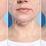 لیپوماتیک غبغب یا لیپوساکشن غبغب – کدام روش نتیجه بهتری دارد؟