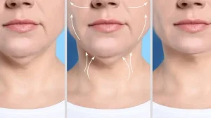 لیپوماتیک غبغب یا لیپوساکشن غبغب – کدام روش نتیجه بهتری دارد؟