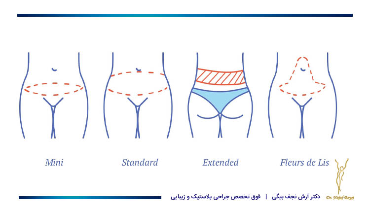 چهار تکنیک ابدومینوپلاستی