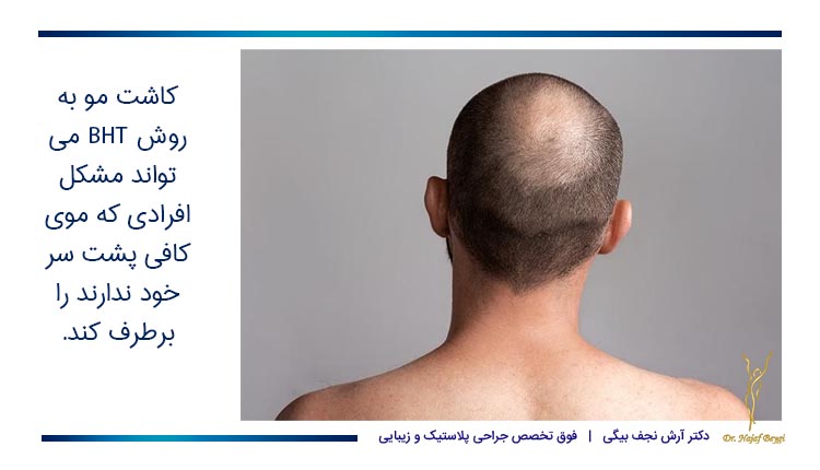 کاشت مو به روش BHT برای افرادی که موی کافی پشت سر خود ندارند