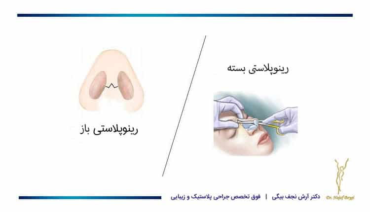 تفاوت رینوپلاستی باز و بسته