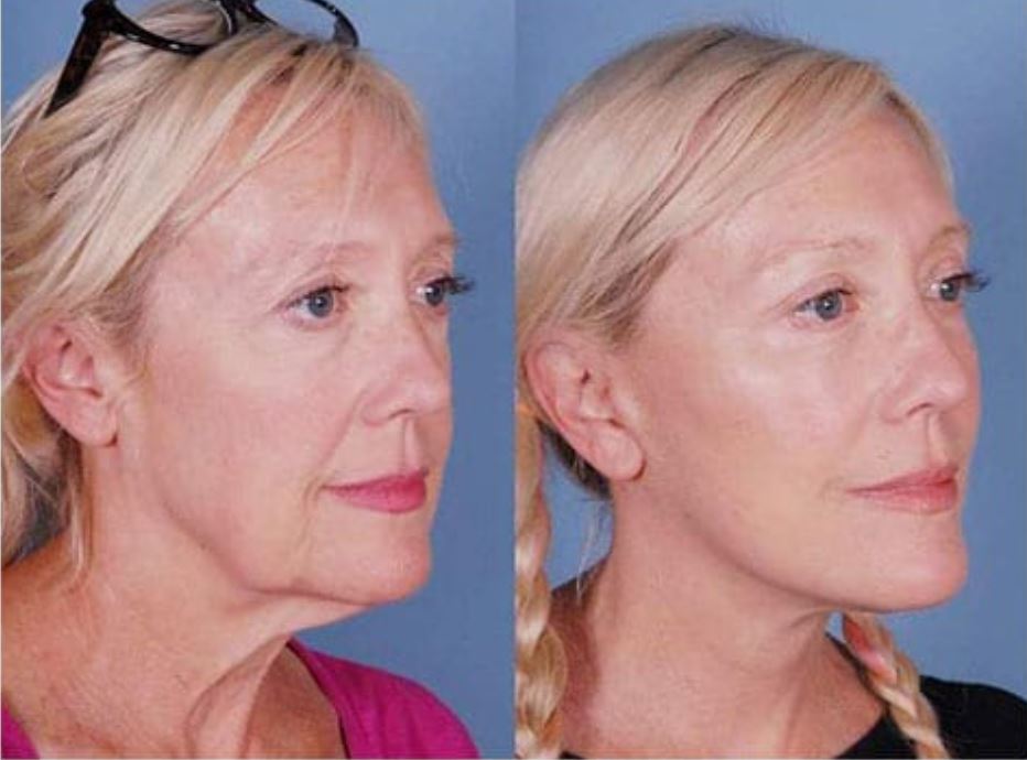 نمونه قبل و بعد جراحی صورت