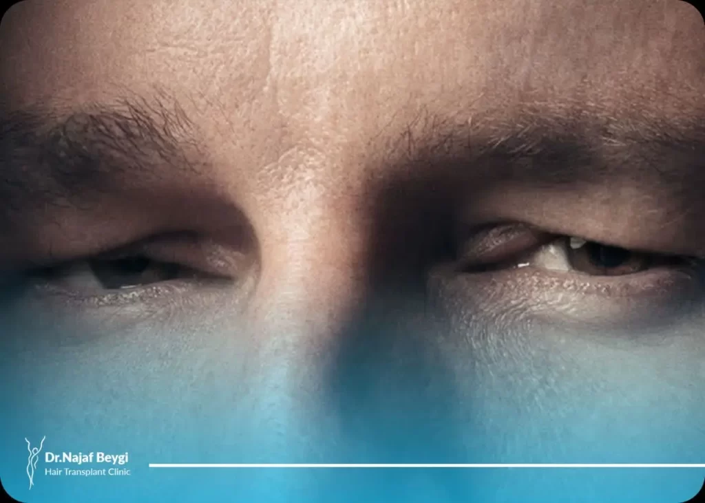 15 روش ساده درمان خانگی پف بالای چشم