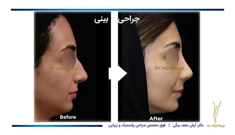 نمونه کار قبل و بعد از عمل بینی قوز دار یک خانم توسط بهترین جراح بینی دکتر نجف بیگی