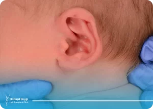 اصلاح گوش های غیرطبیعی و بدشکل نوزادان